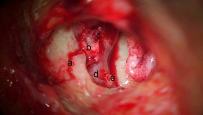 Facial Nerve Decompression After Temporal Bone Fracture—The Bangalore Protocol